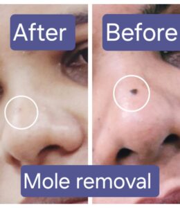 Mole Removal