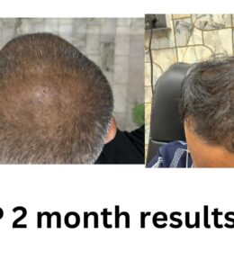 PRP 2 Months Results