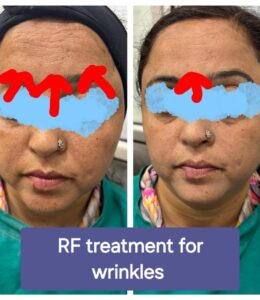 RF treatment for wrinkles