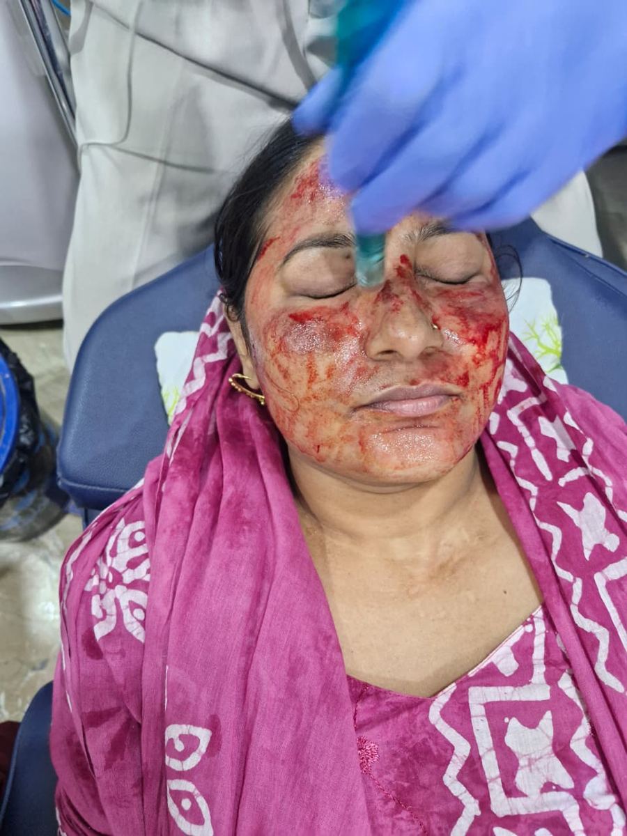 PRP facial with microneedling in progress