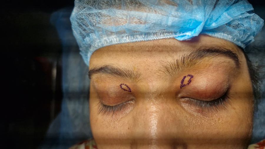 Xanthelasma patches marked on both upper eyelids before the procedure