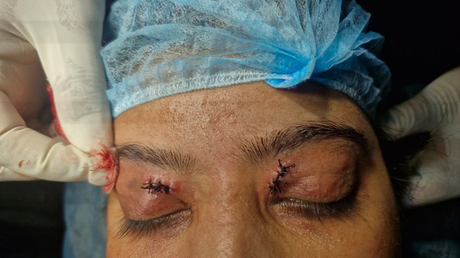 Eyelids closed with fine stitches right after xanthelasma removal